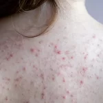 Products that Help Get Rid of Back Acne