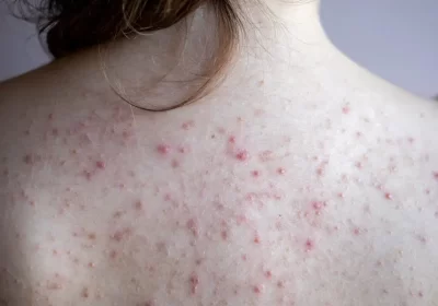 Products that Help Get Rid of Back Acne